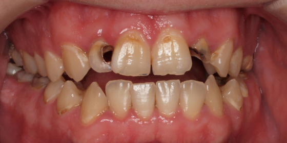 किराले खाएको दाँत कसरी पार्ने निको जान्नुहोस् यि तरीका