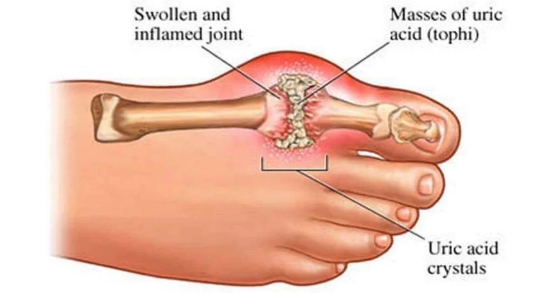 युरिक एसिड बढ्यो : के गर्ने ? के छ घरेलु उपचार 